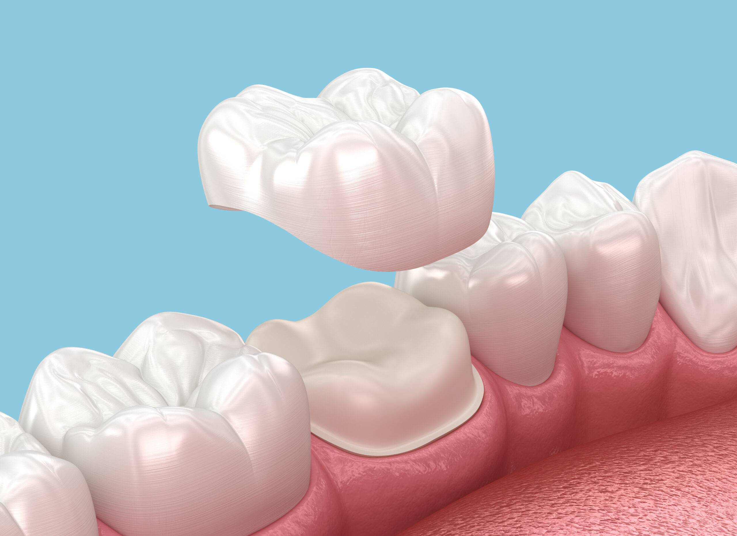 Dental Crowns scaled