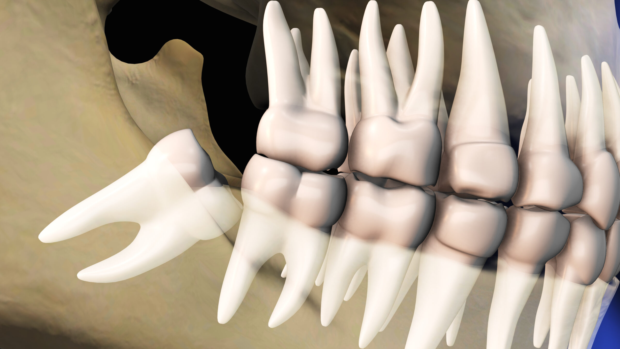 Wisdom Teeth Extraction scaled