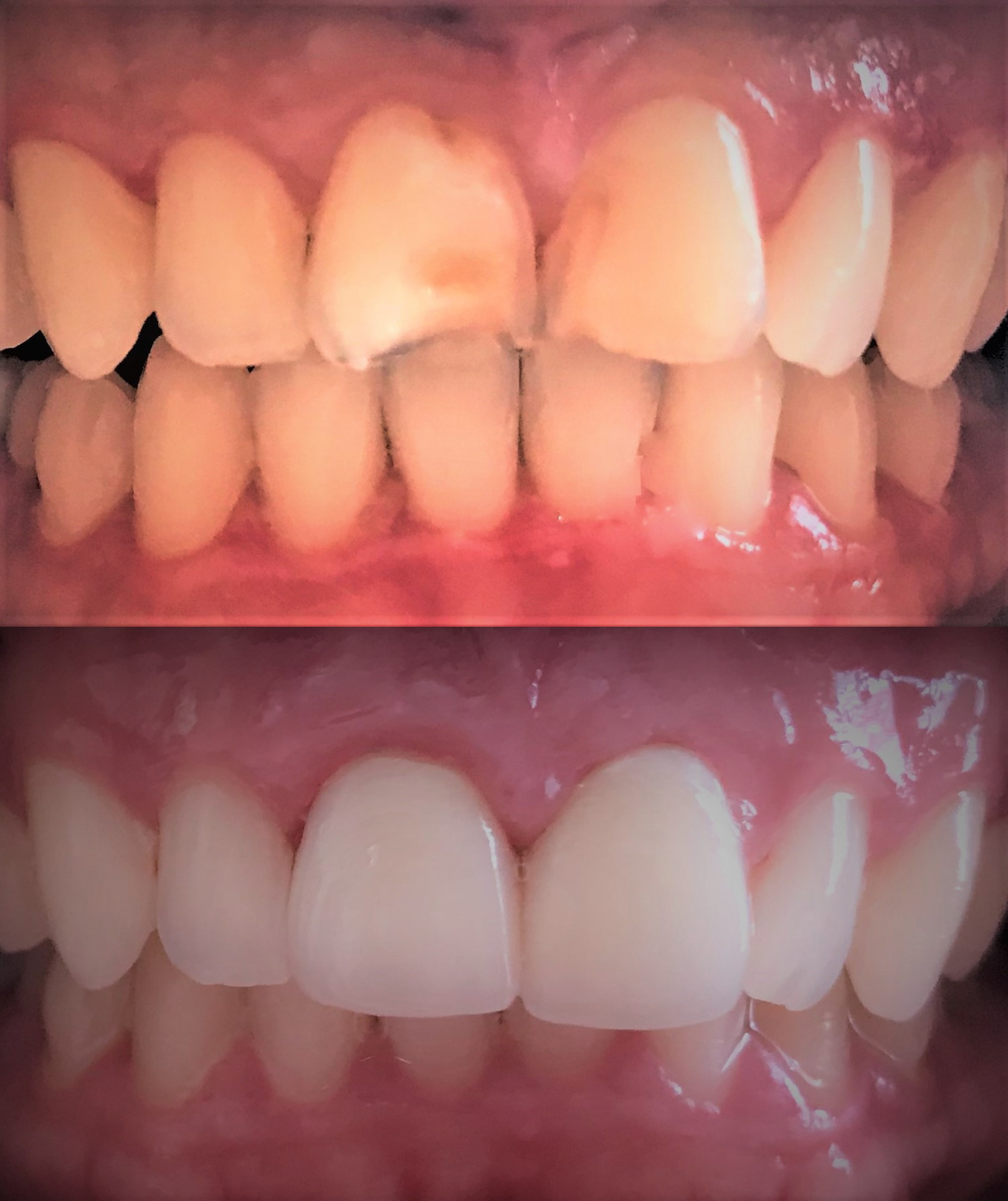original front teeth fixed with veneers confidence restored 1