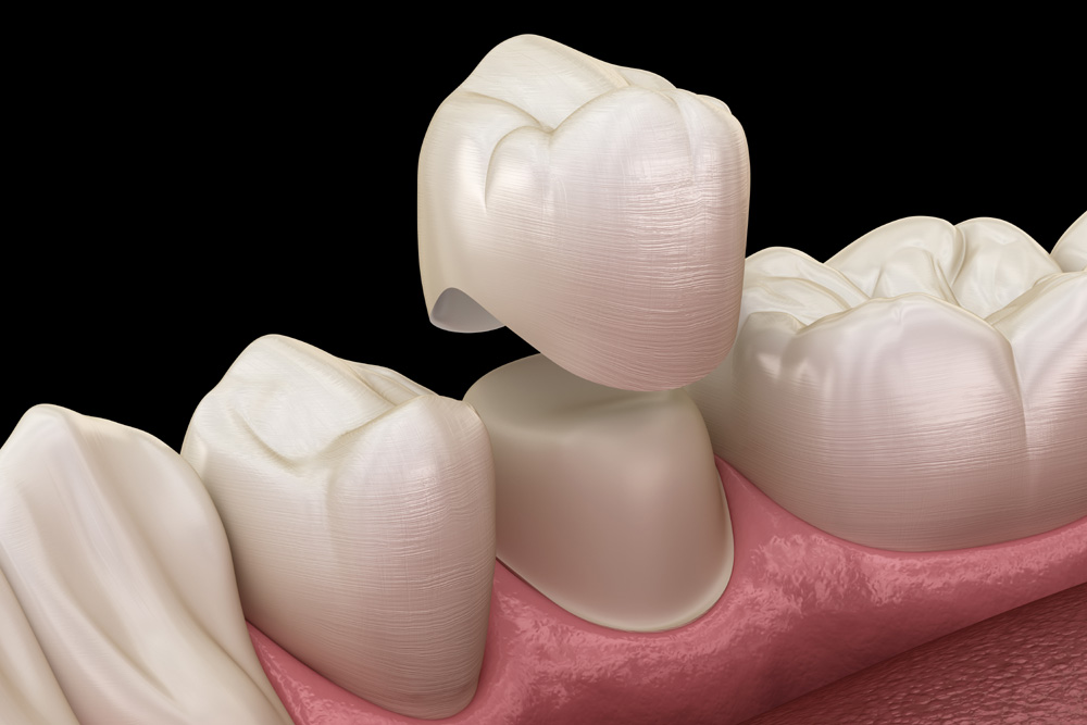 Dental crown premolar tooth assembly process
