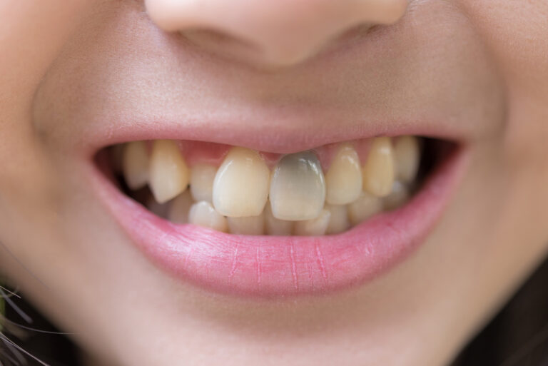 teeth discoloration,teeth change color